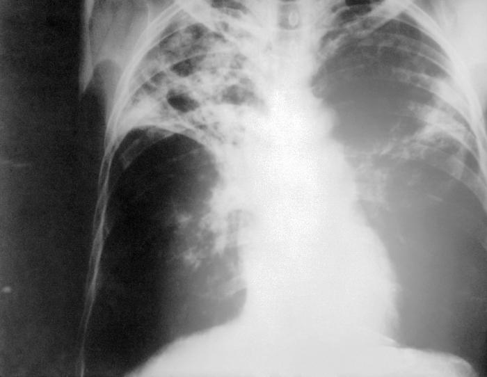 File:Radiography 1972 Center for Disease Control and Prevention Far Advanced Tuberculosis.jpg